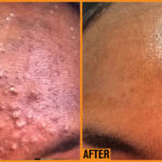 Combination Treatment